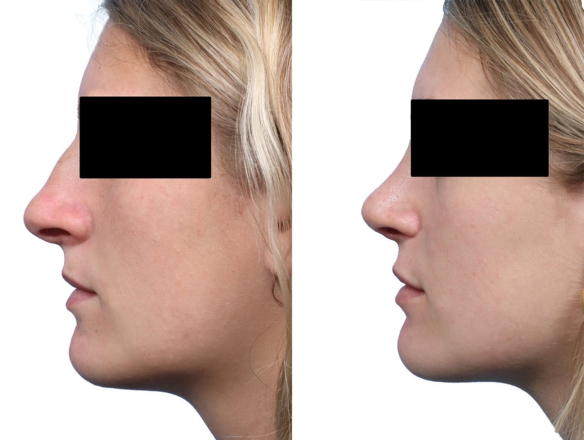 Rhinoplasty Before & After Gallery - Patient 369855 - Image 2