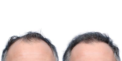 FUE Hair Transplant Before & After Gallery - Patient 340269 - Image 1
