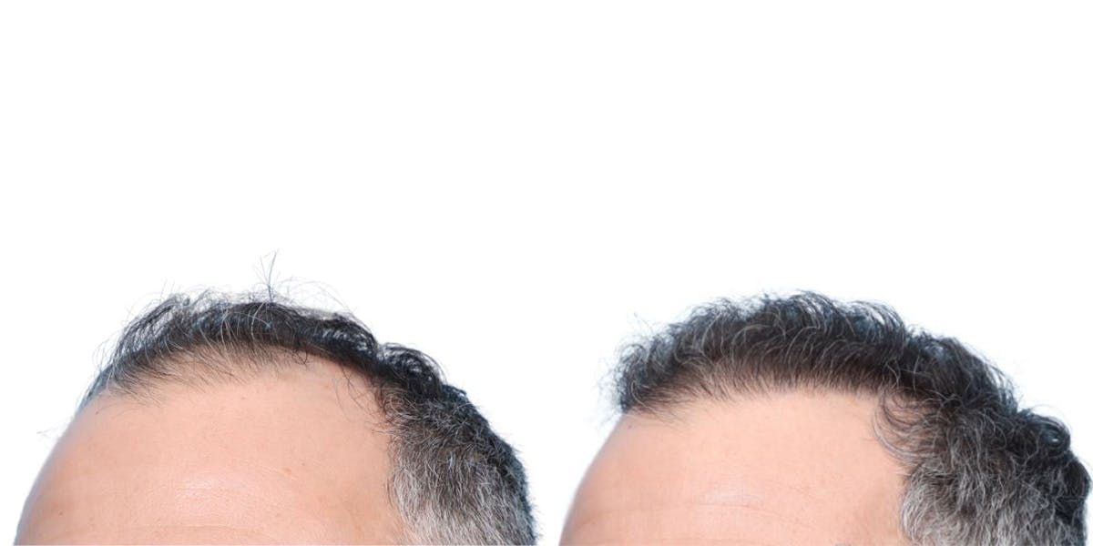 FUE Hair Transplant Before & After Gallery - Patient 340269 - Image 2
