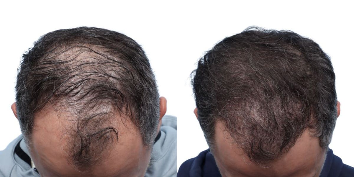 FUE Hair Transplant Before & After Gallery - Patient 340269 - Image 3