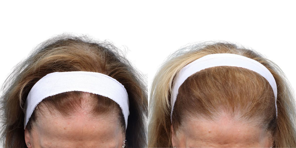 Platelet-Rich-Plasma Before & After Gallery - Patient 164660 - Image 1