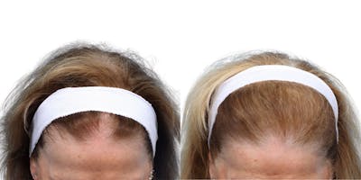 Platelet-Rich-Plasma Before & After Gallery - Patient 164660 - Image 1