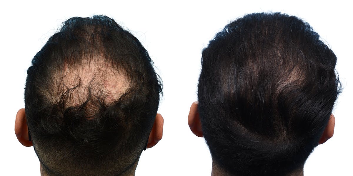 FUE Hair Transplant Before & After Gallery - Patient 272833 - Image 2