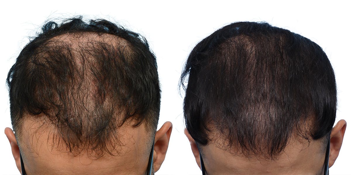 FUE Hair Transplant Before & After Gallery - Patient 272833 - Image 1