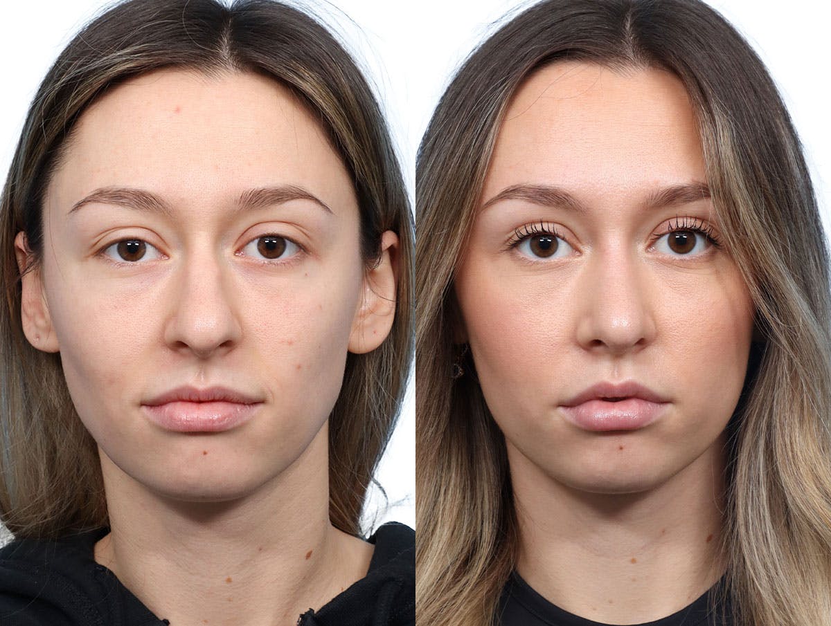 Rhinoplasty Before & After Gallery - Patient 246514 - Image 2
