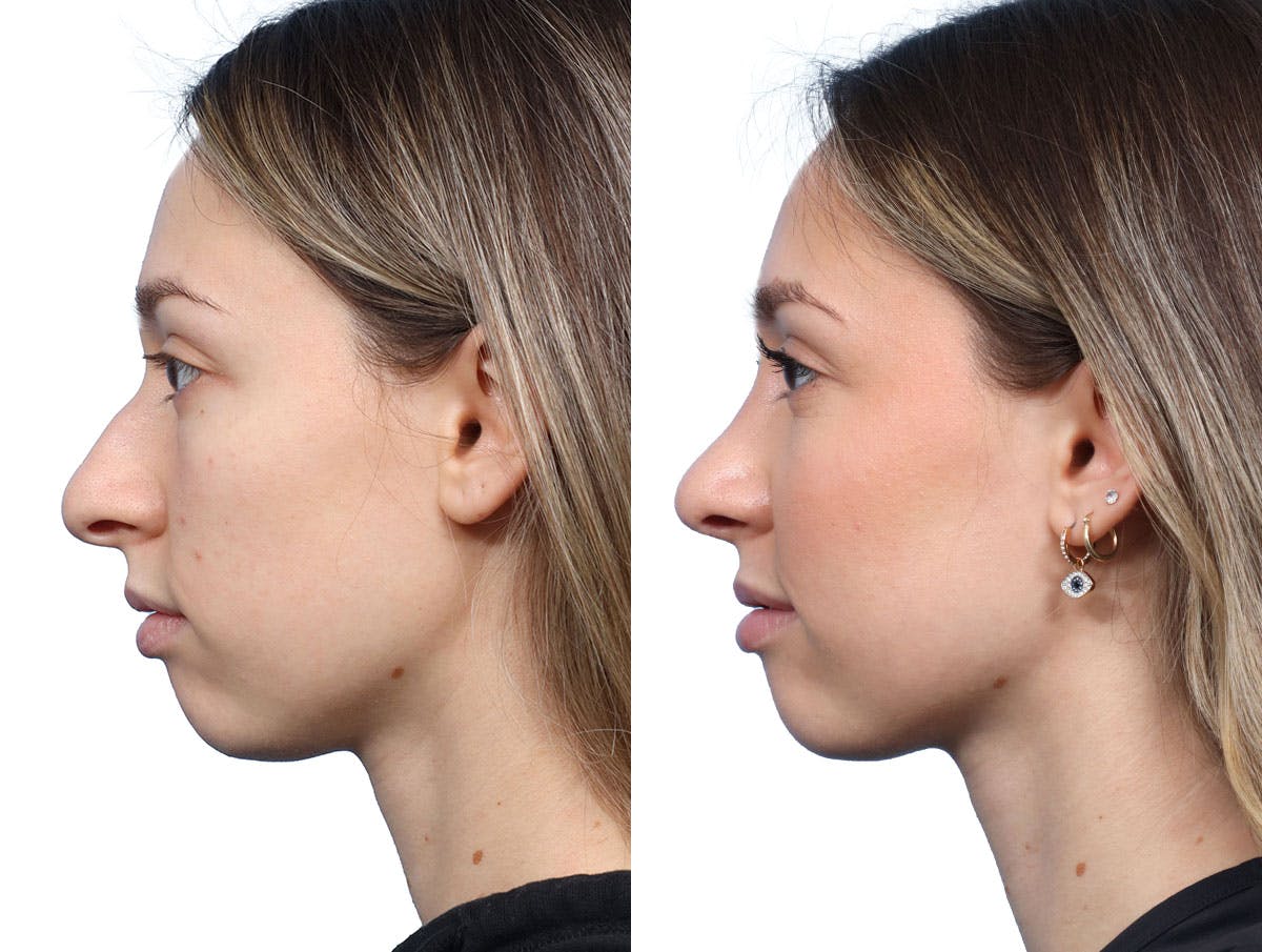 Rhinoplasty Before & After Gallery - Patient 246514 - Image 3