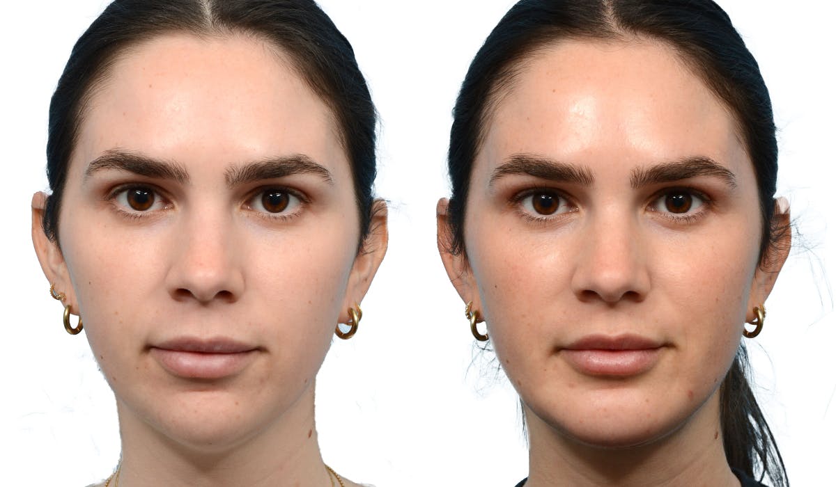 Chin Augmentation Before & After Gallery - Patient 376593 - Image 2