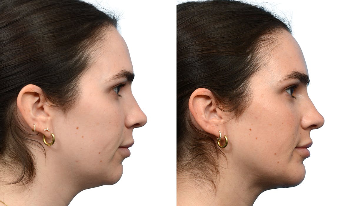 Chin Augmentation Before & After Gallery - Patient 376593 - Image 1
