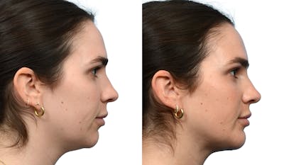 Chin Augmentation Before & After Gallery - Patient 376593 - Image 1