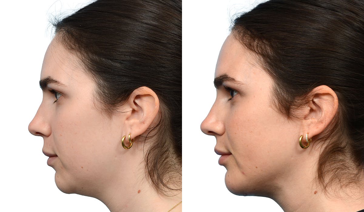 Chin Augmentation Before & After Gallery - Patient 376593 - Image 3