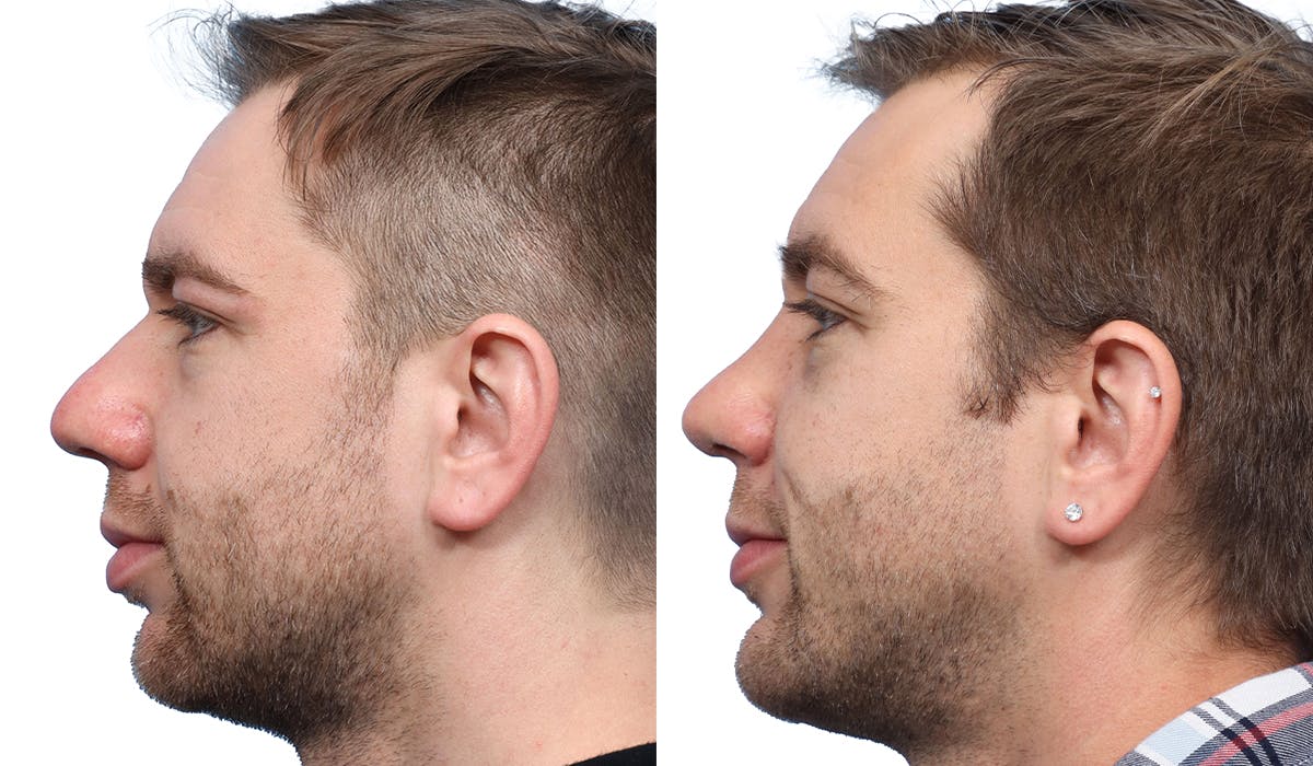 Chin Augmentation Before & After Gallery - Patient 698319 - Image 2