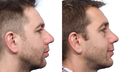Chin Augmentation Before & After Gallery - Patient 698319 - Image 1