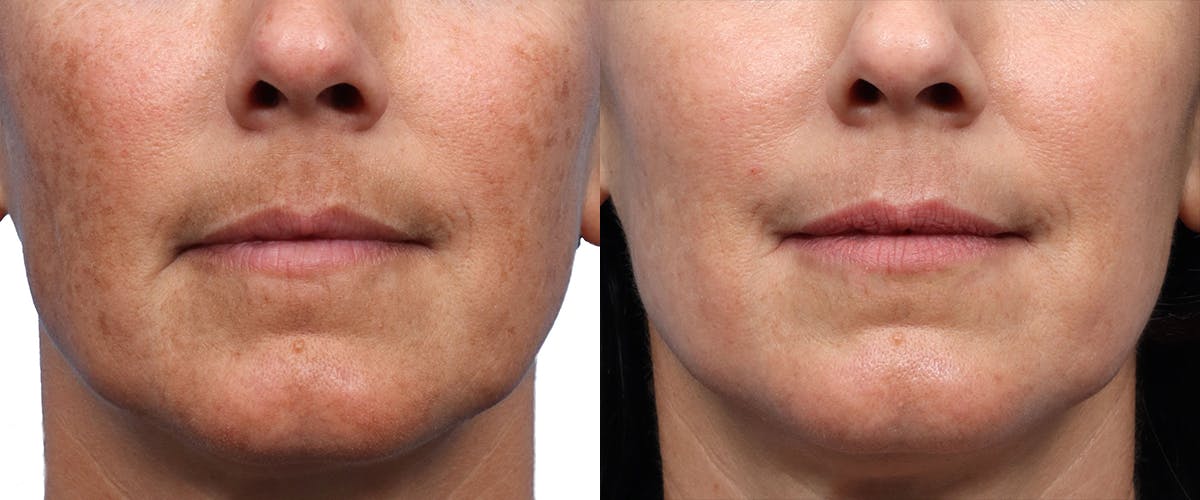 Lutronic Ultra Before & After Gallery - Patient 120551 - Image 1