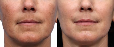 Lutronic Ultra Before & After Gallery - Patient 120551 - Image 1