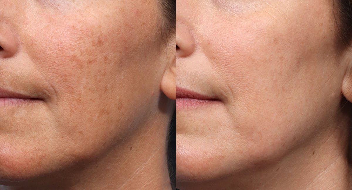 Lutronic Ultra Before & After Gallery - Patient 120551 - Image 3