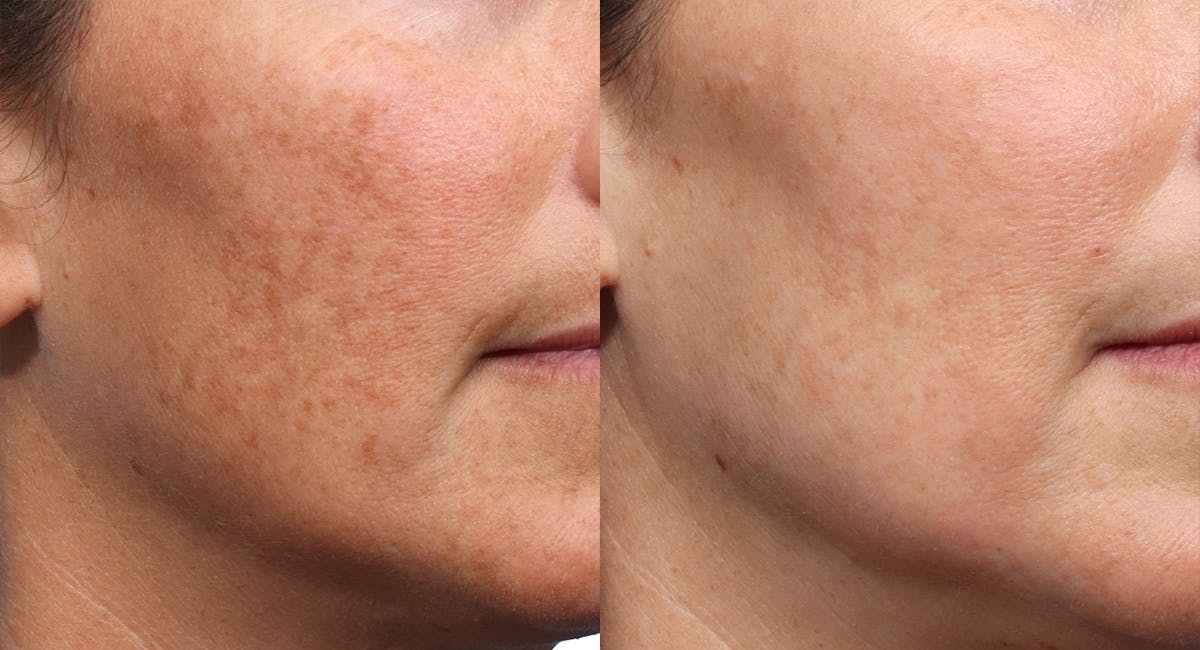 Lutronic Ultra Before & After Gallery - Patient 120551 - Image 2