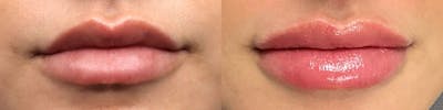 Lip Enhancement Before & After Gallery - Patient 497957 - Image 1