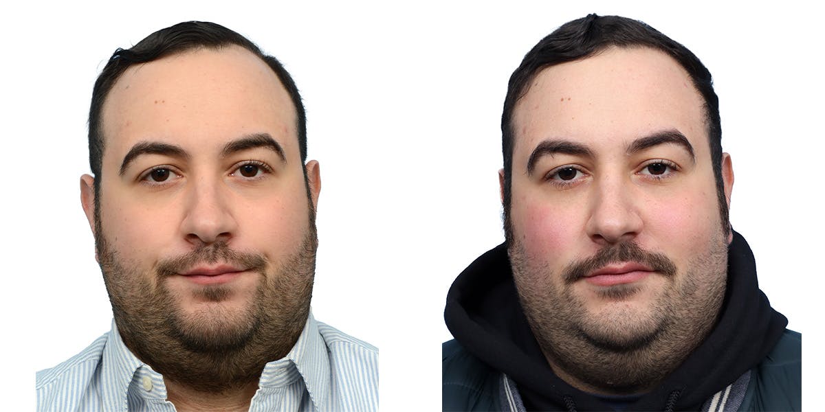 FUE Hair Transplant Before & After Gallery - Patient 149353 - Image 1