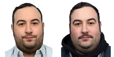 FUE Hair Transplant Before & After Gallery - Patient 149353 - Image 1