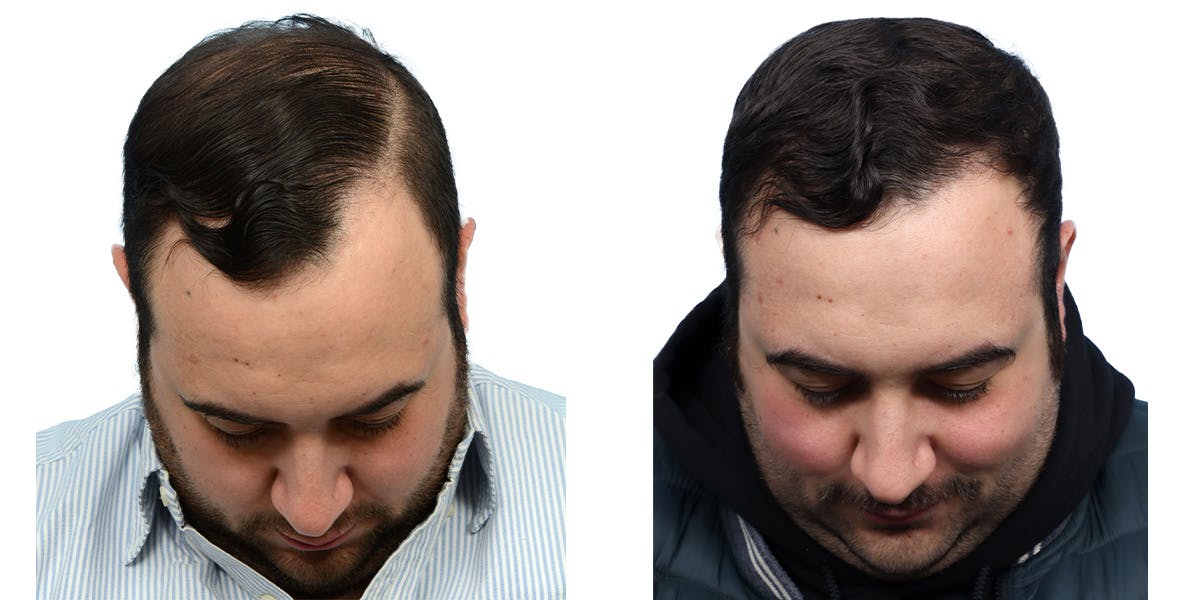 FUE Hair Transplant Before & After Gallery - Patient 149353 - Image 2