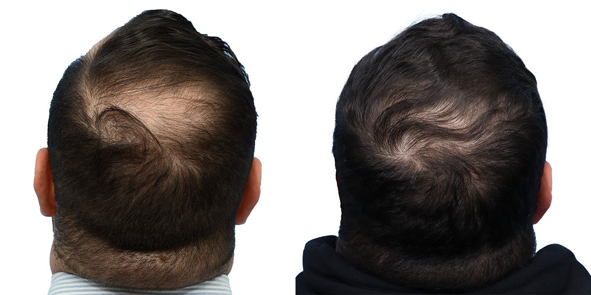 FUE Hair Transplant Before & After Gallery - Patient 149353 - Image 3