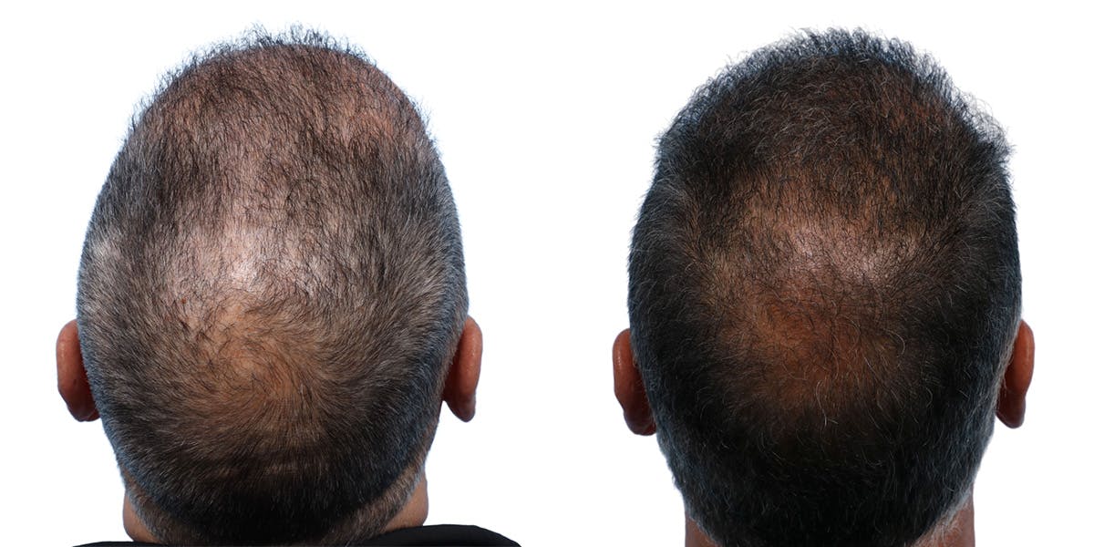 FUE Hair Transplant Before & After Gallery - Patient 867011 - Image 1