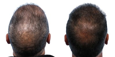 FUE Hair Transplant Before & After Gallery - Patient 867011 - Image 1