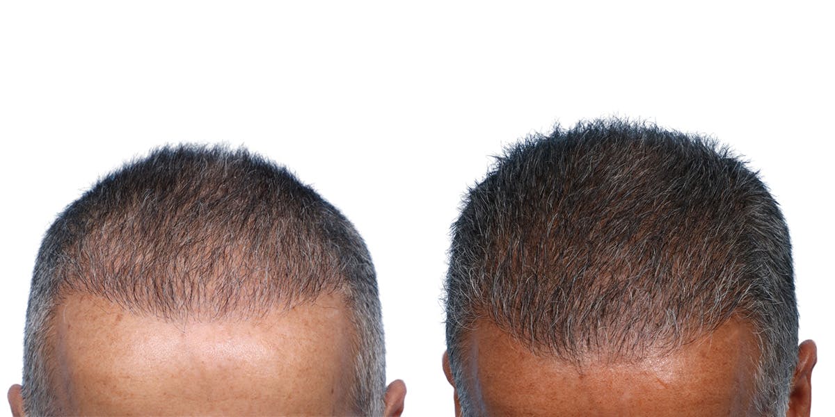 FUE Hair Transplant Before & After Gallery - Patient 867011 - Image 2