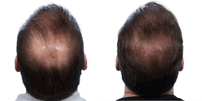 FUE Hair Transplant Before & After Gallery - Patient 371199 - Image 1