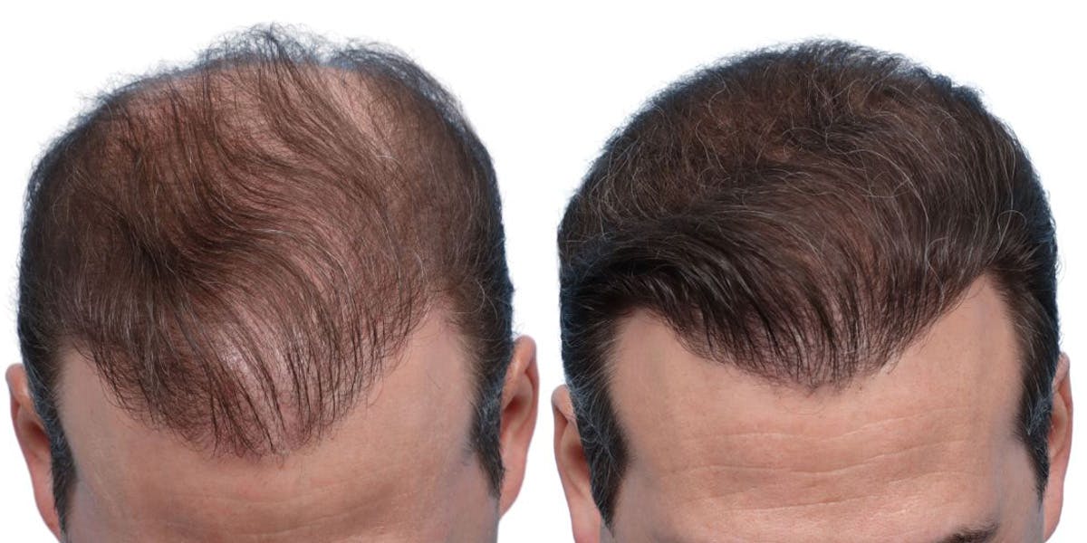 FUE Hair Transplant Before & After Gallery - Patient 371199 - Image 2