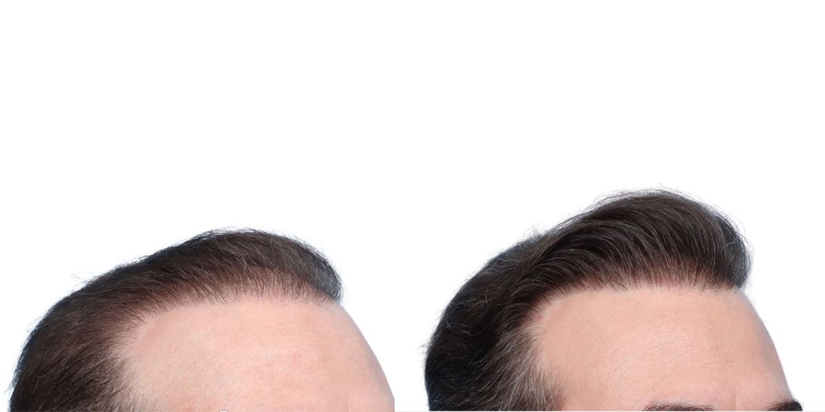 FUE Hair Transplant Before & After Gallery - Patient 371199 - Image 4