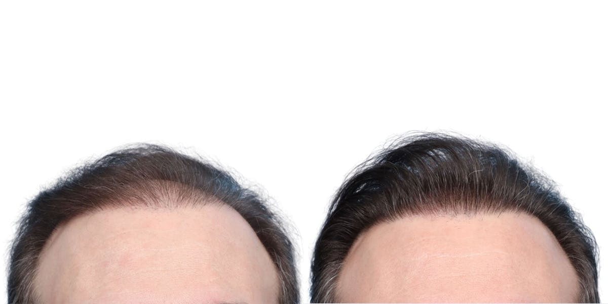 FUE Hair Transplant Before & After Gallery - Patient 371199 - Image 3