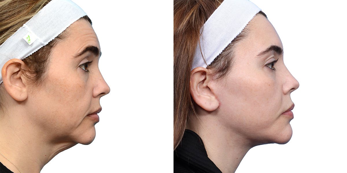 Deep Plane Facelift Before & After Gallery - Patient 233398 - Image 2