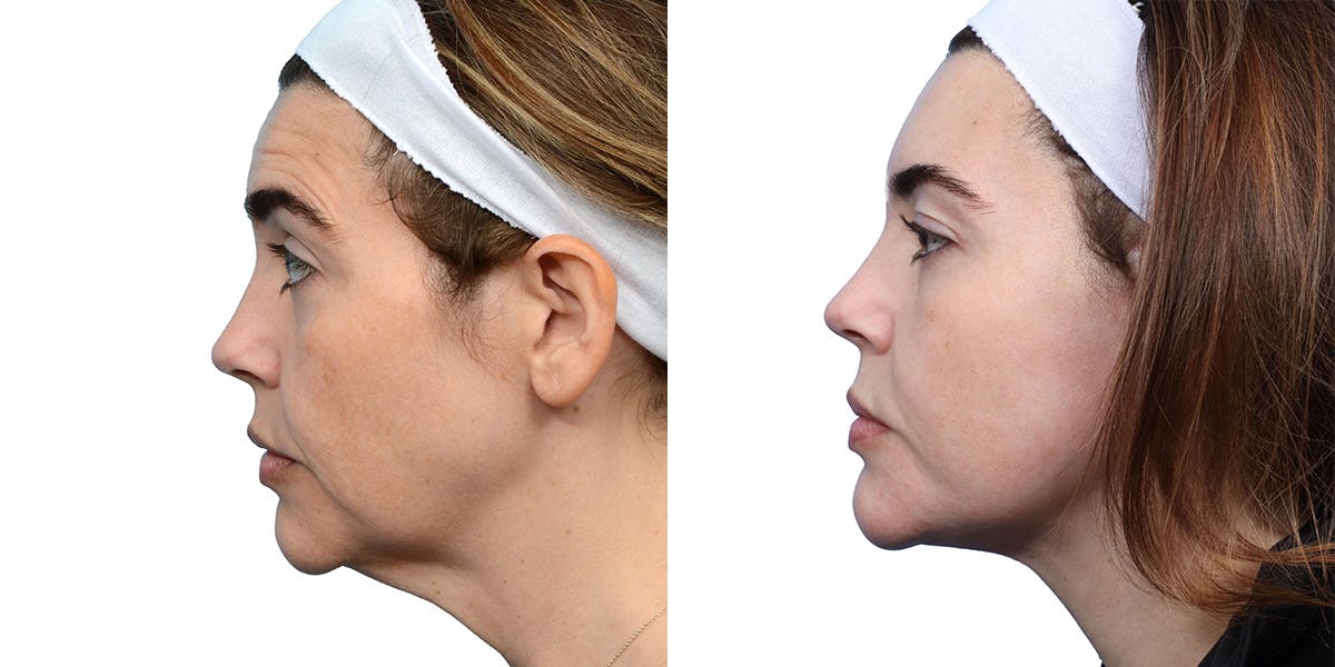 Deep Plane Facelift Before & After Gallery - Patient 233398 - Image 3