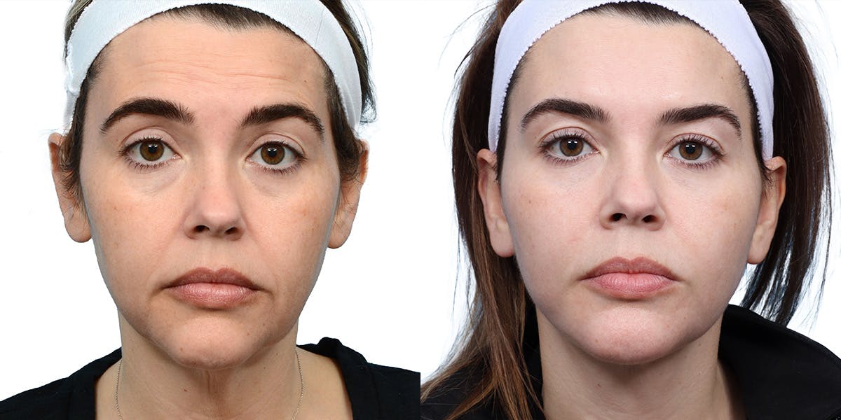 Deep Plane Facelift Before & After Gallery - Patient 233398 - Image 1