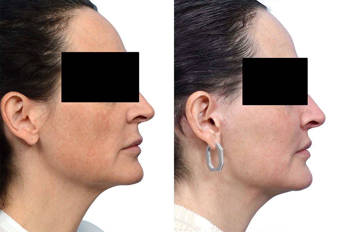 CO2 Laser Before & After Gallery - Patient 162674 - Image 2