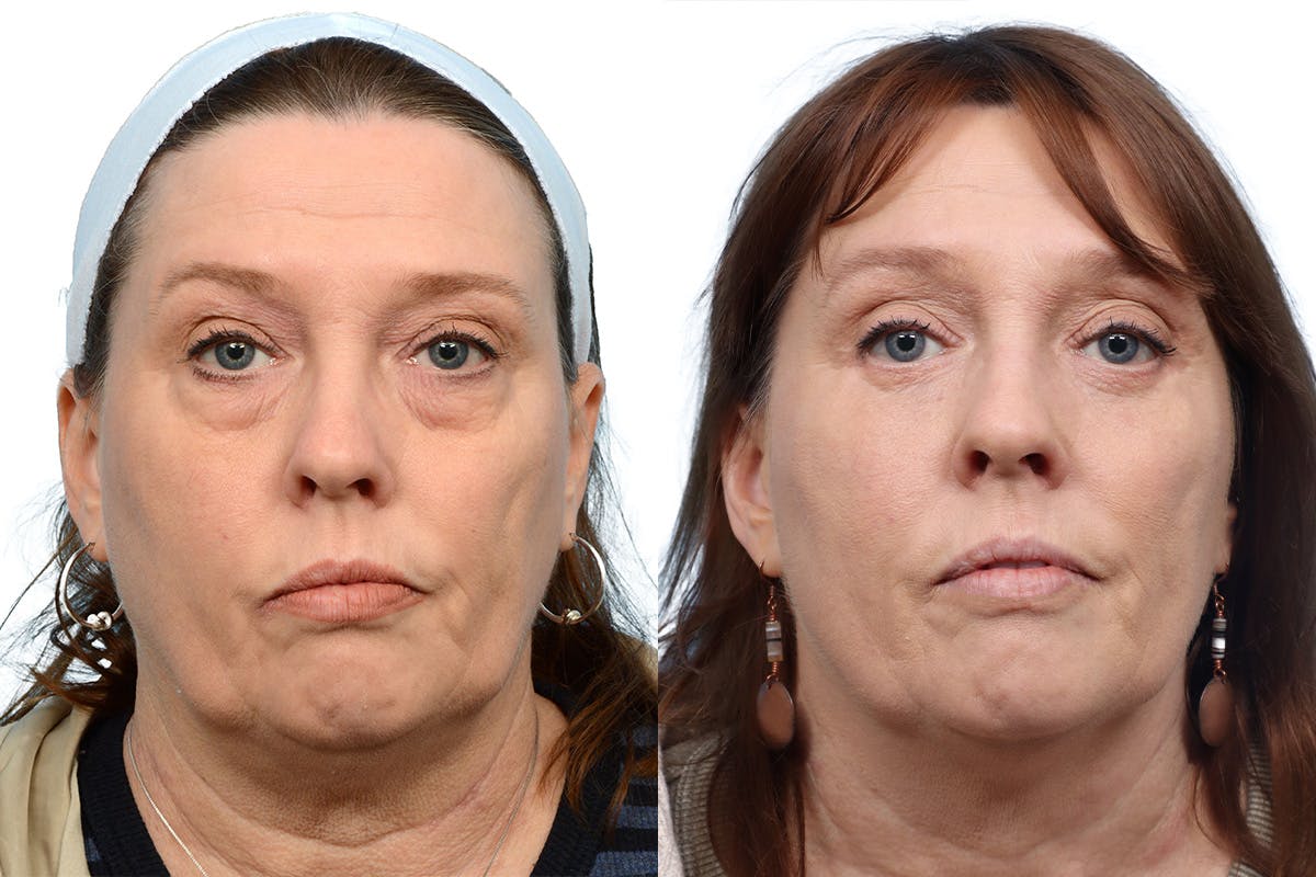 Blepharoplasty (Eyelid Surgery) Before & After Gallery - Patient 276187 - Image 1