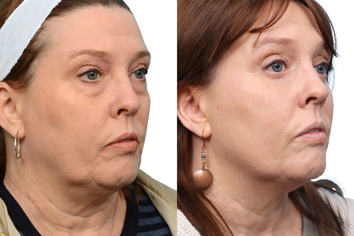 Blepharoplasty (Eyelid Surgery) Before & After Gallery - Patient 276187 - Image 2