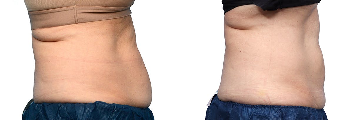 CoolSculpting® Before & After Gallery - Patient 312626 - Image 1
