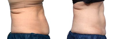 CoolSculpting® Before & After Gallery - Patient 312626 - Image 1