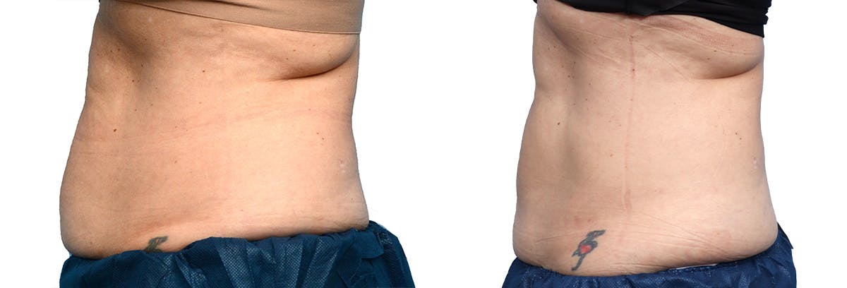 CoolSculpting® Before & After Gallery - Patient 312626 - Image 2