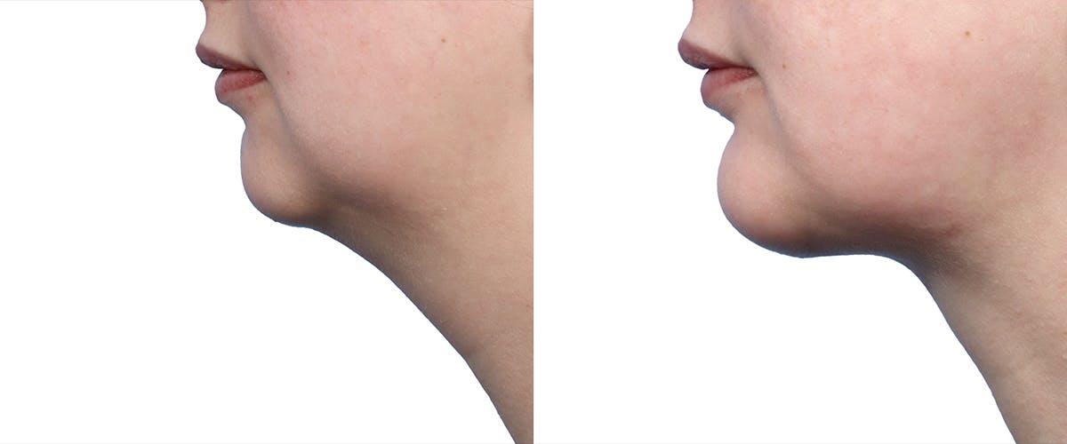 Submental Liposuction Before & After Gallery - Patient 145127 - Image 2