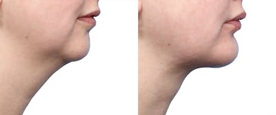 Chin Augmentation Before & After Gallery - Patient 353576 - Image 1