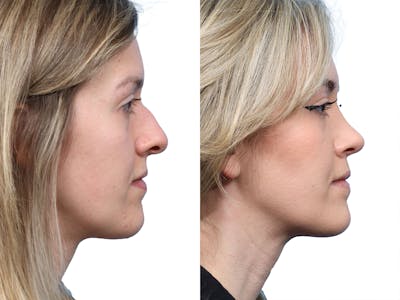 Rhinoplasty Before & After Gallery - Patient 281132 - Image 1