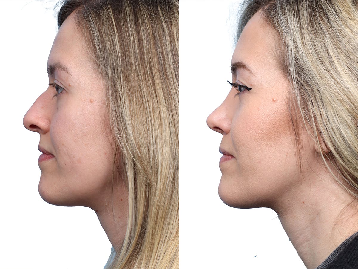 Rhinoplasty Before & After Gallery - Patient 281132 - Image 3