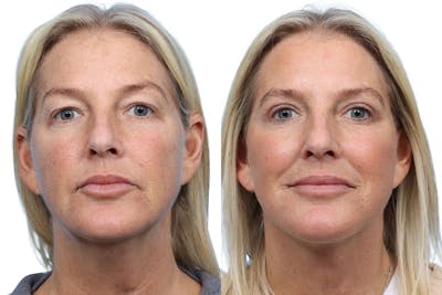 Deep Plane Facelift Before & After Gallery - Patient 326429 - Image 1