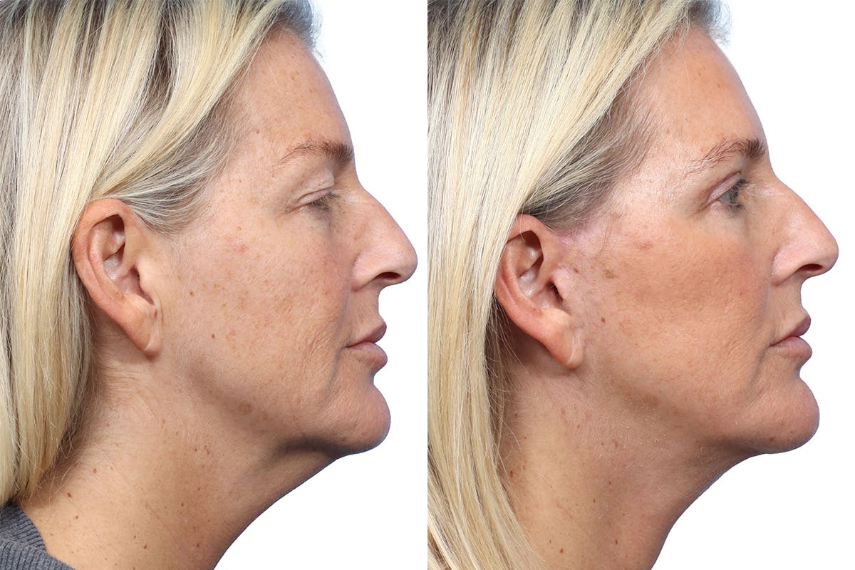 Deep Plane Facelift Before & After Gallery - Patient 326429 - Image 2