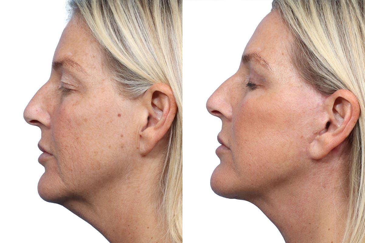Deep Plane Facelift Before & After Gallery - Patient 326429 - Image 3