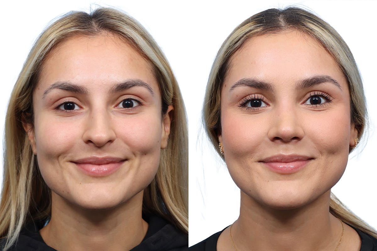 Rhinoplasty Before & After Gallery - Patient 252896 - Image 3