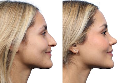 Rhinoplasty Before & After Gallery - Patient 252896 - Image 1